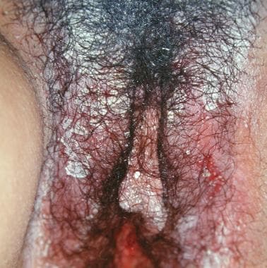 Benign vulvar lesions. Allergic vulvitis. 