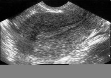 Infertility. Sonogram: Sagittal view of the uterus