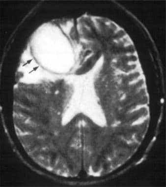 Brain abscess. Axial T2-weighted MRI in a patient 