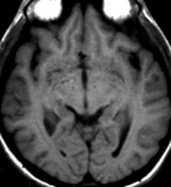T1-weighted magnetic resonance image demonstrates 