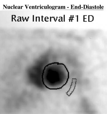 End-diastolic cardiac nuclear ventriculogram (obta