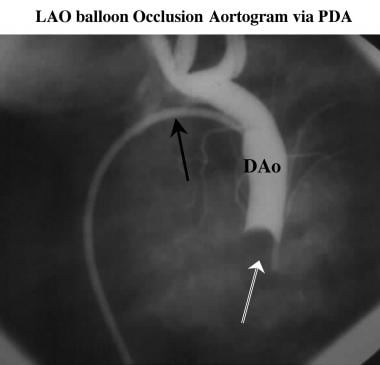 Left anterior oblique balloon-occlusion aortogram.