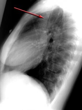 Lateral chest radiograph demonstrates a pneumomedi