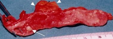 Suppurative appendicitis in a 15-year-old boy; lon