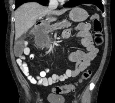 Recurrence at the ileocolic anastomosis in a 58-ye