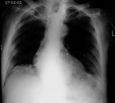 A plain chest radiograph showing a well-defined, r