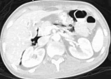 Mesenteric ischemia. CT scan obtained by using lun