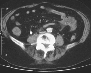 Enhanced axial CT scan of the mid abdomen in a 67-