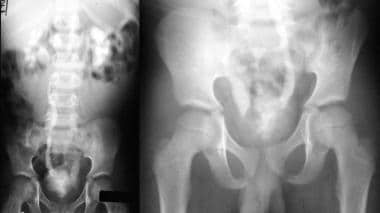Intravenous urogram in a 6-year-old boy shows gran