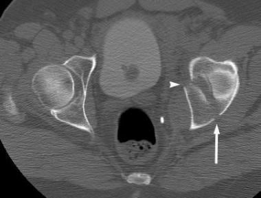 Computed tomography (CT) scan of T-shaped acetabul