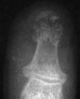 Radiograph of the thumb shows a crush fracture of 