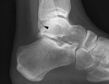 Lateral view of the ankle reveals a linear calcifi