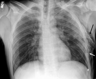This anteroposterior (AP) chest radiograph demonst