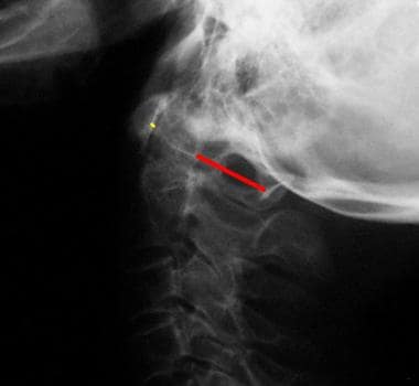 Plain lateral radiograph of the normal cervical sp