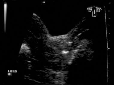 Sagittal transabdominal sonogram of clinical stage