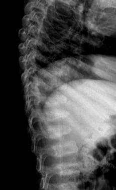 Lateral spinal radiograph in a 1-year-old boy with