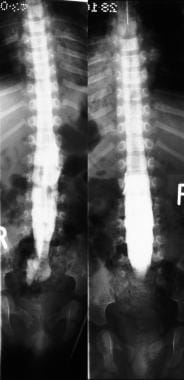 Myelograms in a 4-year-old patient show the lumbos