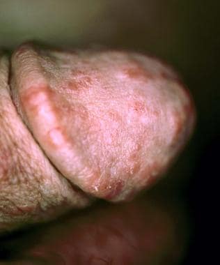 Scabies (Image courtesy of Hon Pak, MD) 