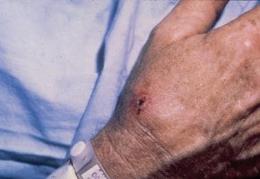 Ulceroglandular type of tularemia on the hand. Cou