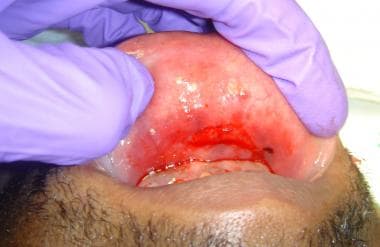 Identification of intraoral skin laceration. 