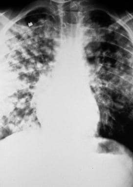 High-altitude pulmonary edema (HAPE). Initial pres