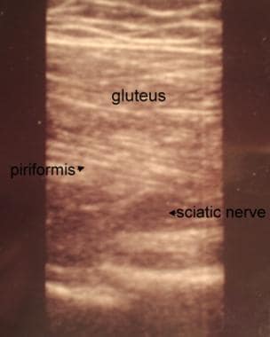 Ultrasonogram identifies sciatic nerve, gluteus, a