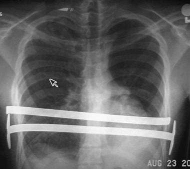 Nuss procedure. Chest radiograph of 17-year old ma