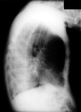Atelectasis. Left lower lobe collapse. The opacity
