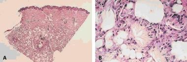 Histopathologic features of subcutaneous fat necro