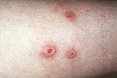 What Is Prurigo Nodularis? Pictures, Causes, Treatment