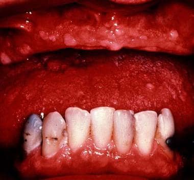 Multiple benign oral fibromas. 