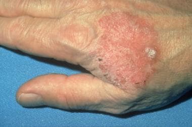 Tinea Corporis: Practice Essentials, Background, Pathophysiology