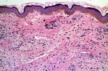 xanthelasma histology