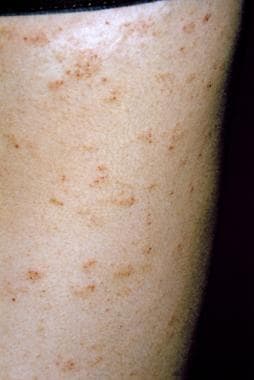 Scabies. Erythematous vesicles and papules are pre