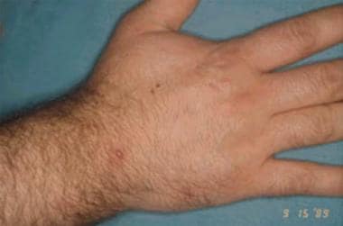 Vesicle on the dorsal hand of a young adult. 