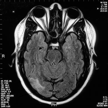 大脑的MRI在一个37岁的男人有神经系统
