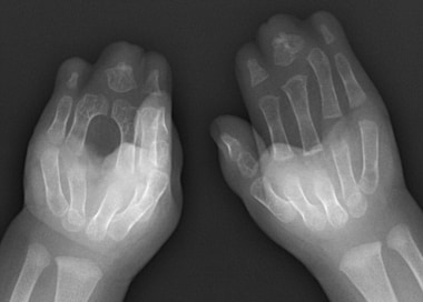 Radiograph of bilateral hands in the same patient 