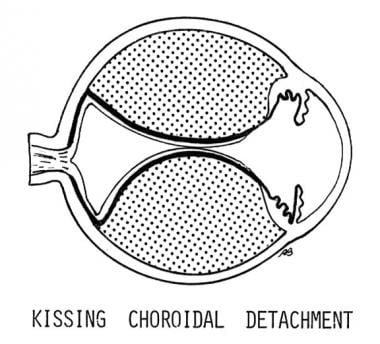 Kissing choroidal detachment. When the lobes of th