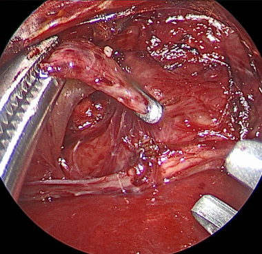 Distal tracheoesophageal fistula is clipped and di
