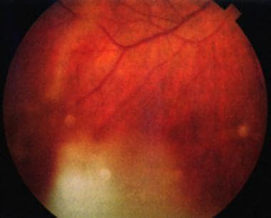 Lens nucleus dislocated into the inferior vitreous