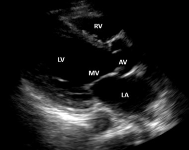 Ultrasound image of the parasternal long-axis view