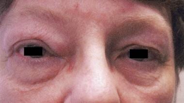 Upper and lower eyelid edema in blepharochalasis s