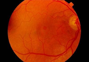 Preoperative fundus photograph of a macular hole. 