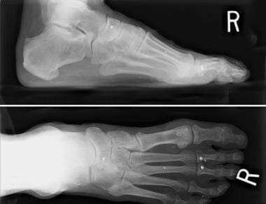 Preoperative radiograph shows hypermobile first ra