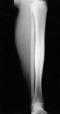 Lateral radiograph of the left tibia. This image d