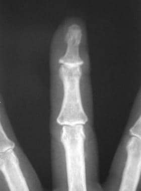 Degenerative changes at the distal interphalangeal