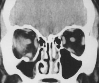 Coronal CT scan (soft tissue window) showing right