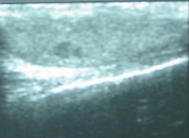 Scrotal sonogram showing a 0.5-cm X 0.4-cm hypoech