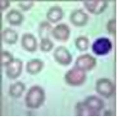 megaloblastic anemia peripheral smear