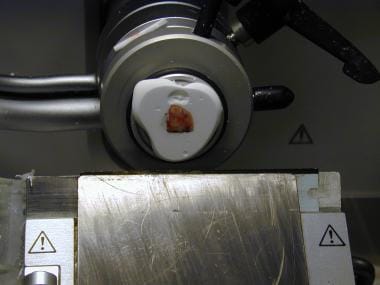 A Mohs surgery tissue specimen is cut into thin se